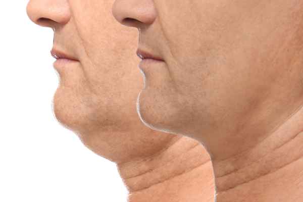 HIFU - Breakthrough in Anti - ageing 2 hifu results Bellshill