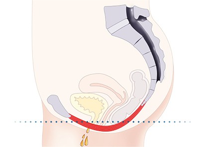 Pelvic-Floor Muscle Repair 5 Pelvic floor muscles Bellshill