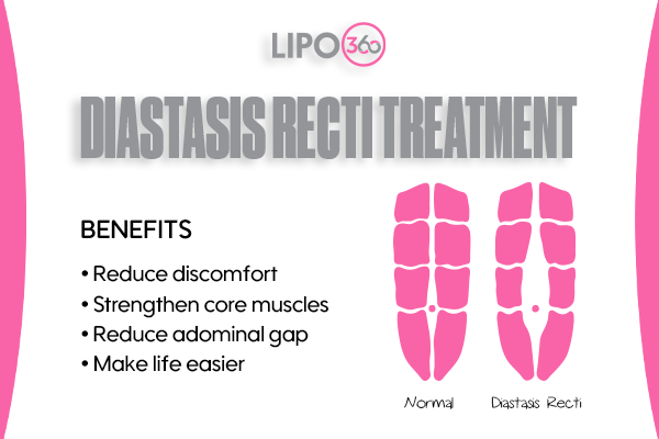 Revolutionising Muscle Repair: The Power of LIPO360 Body Sculpt Post-Injury 5 diastasis recti treatment Bellshill
