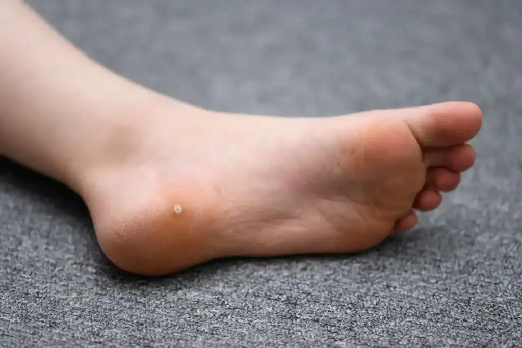 Cryotherapy For Warts And Also Verrucas 2 Image of verruca on the bottom of the foot that able to be treated with Cryotherapy Bellshill