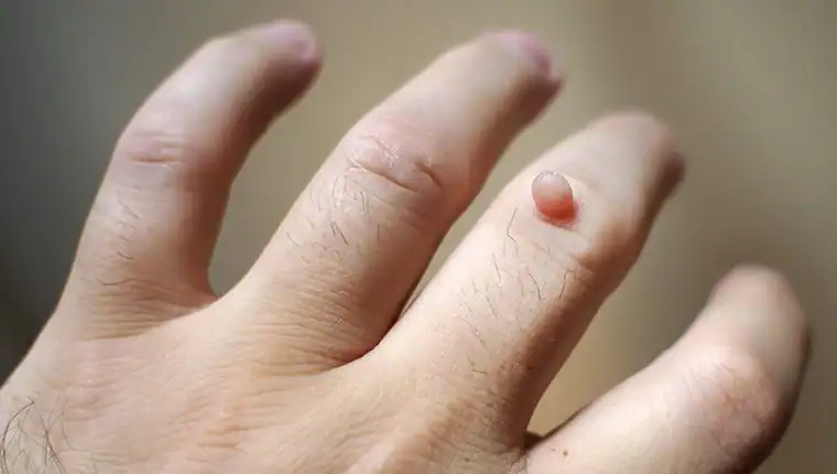 Cryotherapy For Warts And Also Verrucas 1 Image of blemish that Cryotherapy Bellshill can remove with Lipo 360.