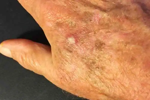Image of Actinic keratoses Bellshill on a person hand