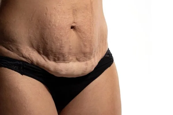 The Science of Skin Tightening 1 The science behind skin tightening Bellshill picture of a woman's sagging skin on the stomach